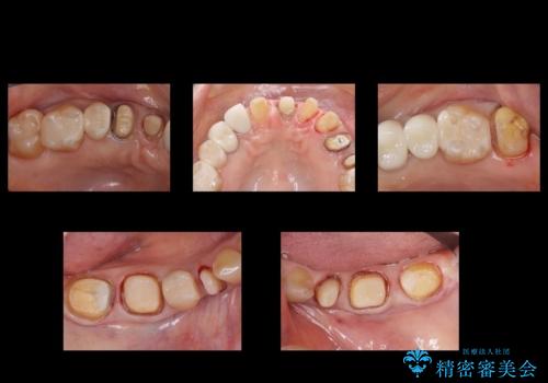 50代女性　銀歯をとって白いつめものに　全体的な治療の治療中