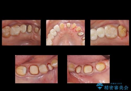 50代女性 銀歯をとって白いつめものに 全体的な治療の治療中