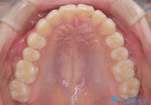 子供の出っ歯 生え代わりと成長期を利用して非抜歯で矯正の治療後