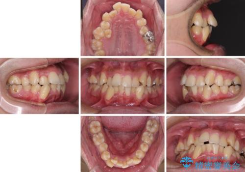 デコボコと口元の突出感を改善　抜歯矯正治療の治療前