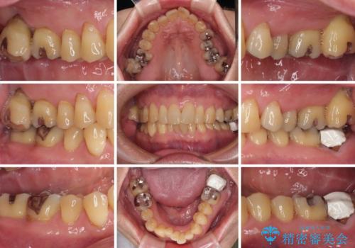外側に飛び出している歯 部分矯正を用いた奥歯の補綴治療の治療前