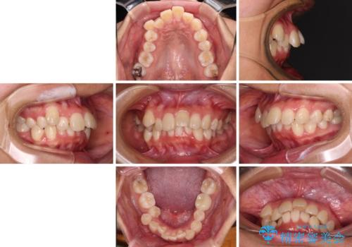 唇を閉じてもはみ出してしまう上顎前歯　抜歯矯正で口元を改善の治療前