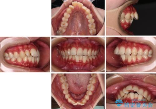 気になる上顎前突 補助装置を用いた抜歯矯正で口元をすっきりとの治療前