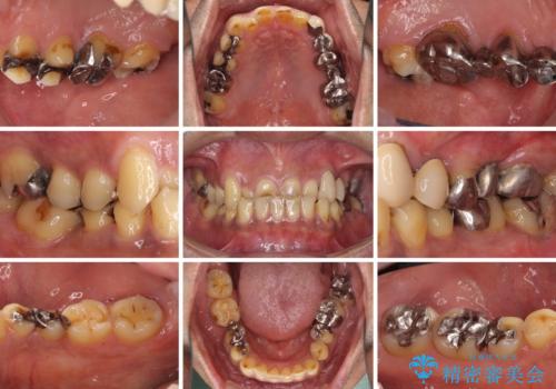 反対咬合ですり減った前歯とむし歯だらけの奥歯　総合歯科治療の治療前