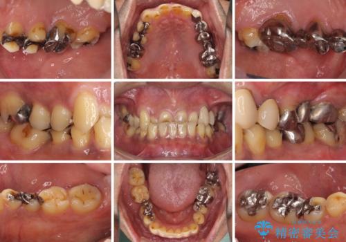 反対咬合ですり減った前歯とむし歯だらけの奥歯 総合歯科治療の治療前