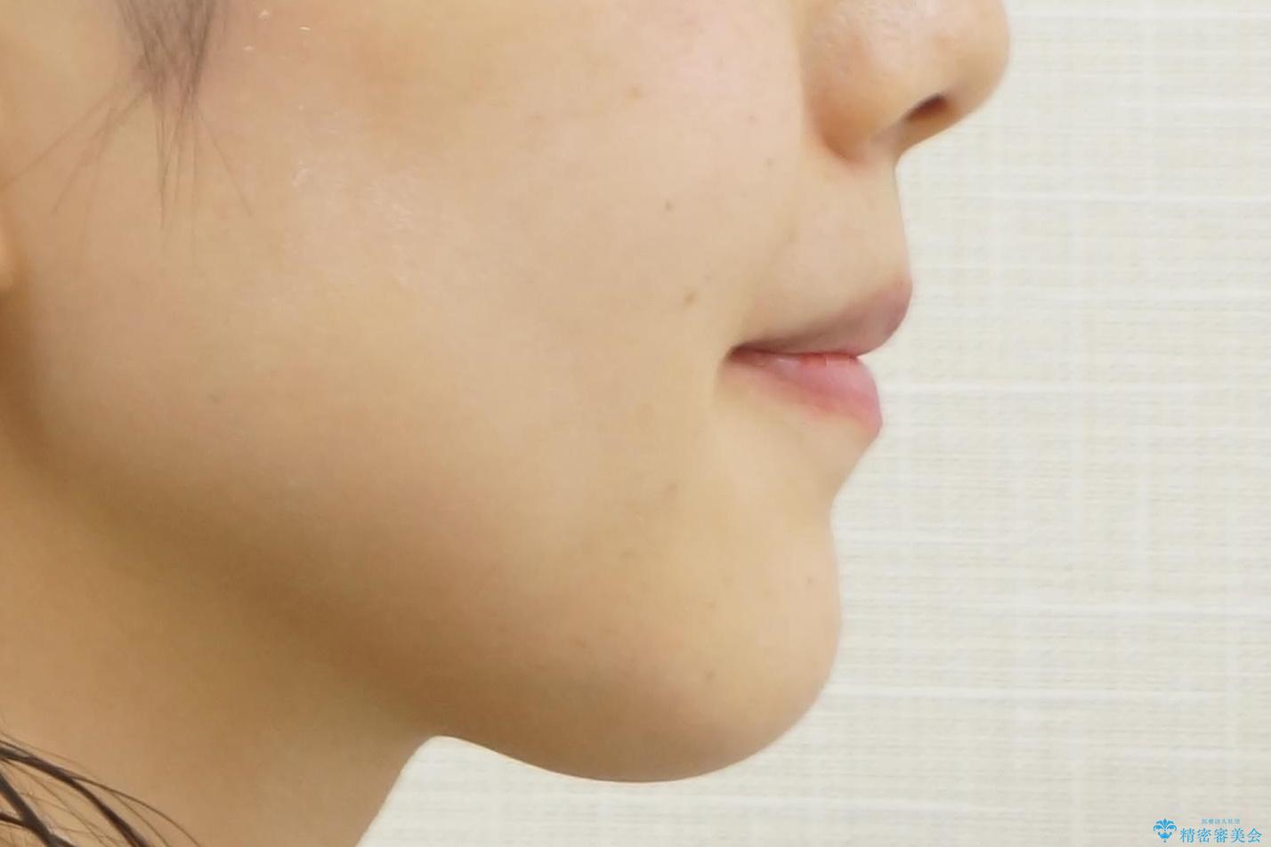 下の前歯のちょっとしたがたつきを治したいの治療後(顔貌)