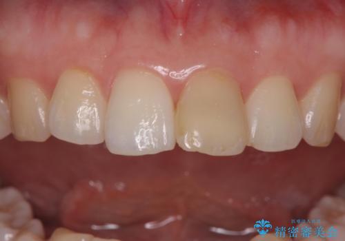 前歯の変色とガタつき ジルコニアクラウンでの修復の治療前