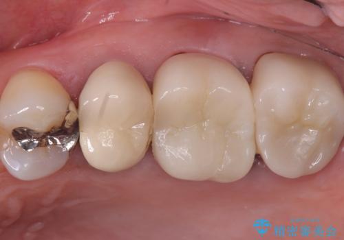 【セラミッククラウン】土台と被せものがズレている気がするの症例 治療前