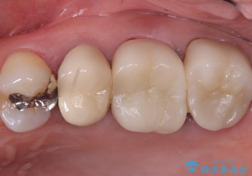 【セラミッククラウン】土台と被せものがズレている気がするの治療前