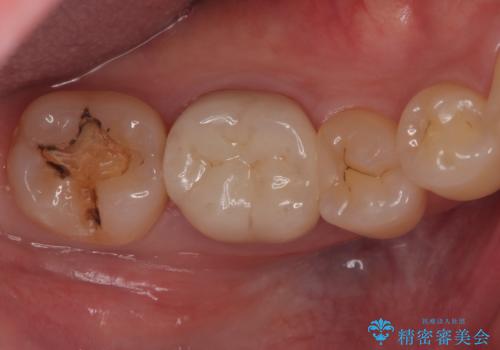 【セラミックインレー】銀の詰め物が取れたの治療前