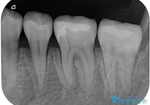 銀歯が目立つのでやり替えたい　セラミックインレー修復の治療後