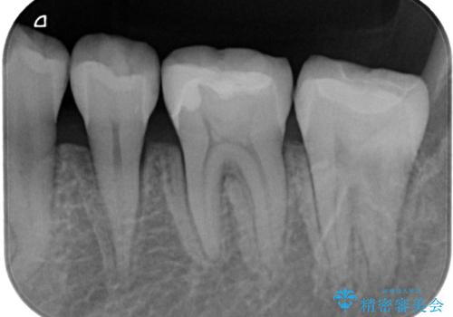 銀歯が目立つのでやり替えたい セラミックインレー修復の治療後