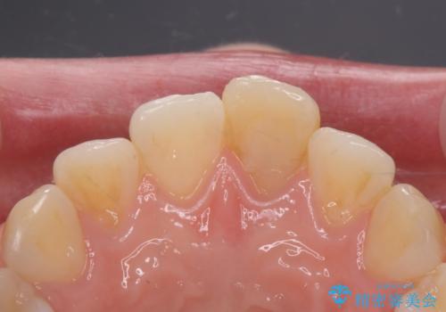 前歯の変色とガタつき ジルコニアクラウンでの修復の治療前