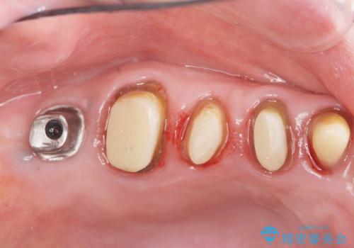 見た目の悪いクラウンをやりかえたいの治療中