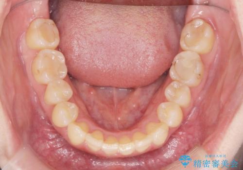 前歯のねじれを治したい リーズナブルなインビザラインモデレートプランの治療中