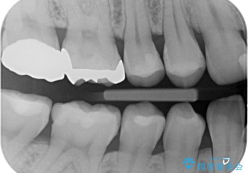 奥歯の虫歯の治療　の治療後