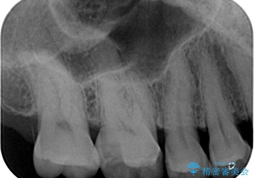 銀の詰め物が外れた ハイブリッドアンレー修復の治療前