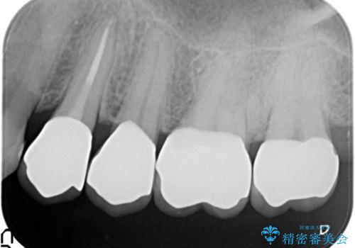ゴールド修復後の虫歯再発 ジルコニアクラウンで精密治療の治療後