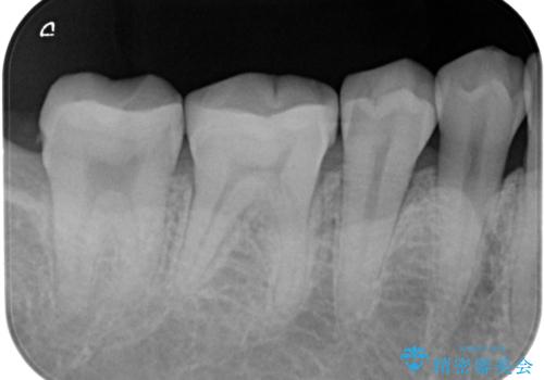 セラミックインレー。の治療後