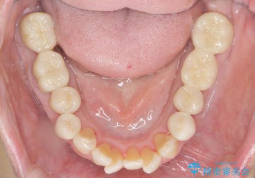 セラミック インプラント 全顎治療の治療後