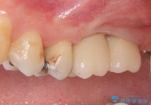 上顎奥歯のインプラント治療の治療後
