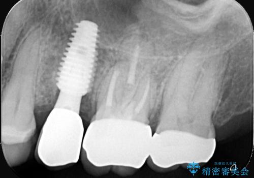 左上第一小臼歯のインプラント治療の治療後