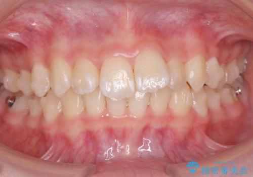 子供の出っ歯 生え代わりと成長期を利用して非抜歯で矯正の治療中