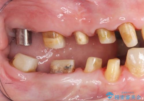 セラミック インプラント 全顎治療の治療中