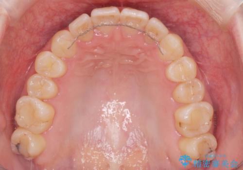 前歯のねじれを治したい リーズナブルなインビザラインモデレートプランの治療後