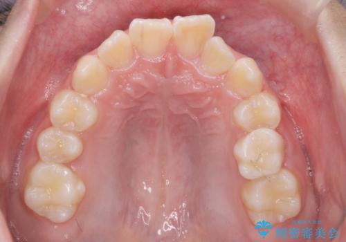 子供の出っ歯 生え代わりと成長期を利用して非抜歯で矯正の治療前
