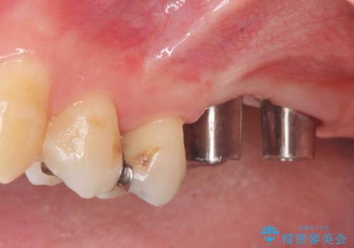 上顎奥歯のインプラント治療の治療中