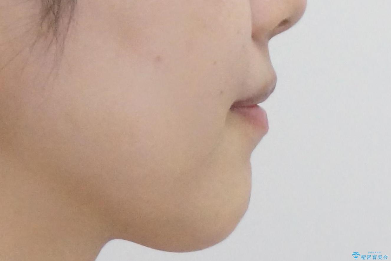 下の前歯のちょっとしたがたつきを治したいの治療前(顔貌)