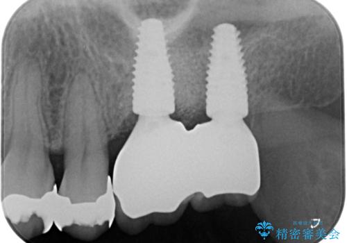 上顎奥歯のインプラント治療の治療後