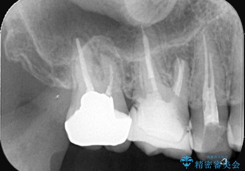 【セラミッククラウン】銀歯をオールセラミックに!の治療後