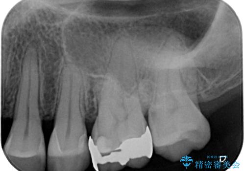 銀歯がとれた セラミックインレー修復の治療後