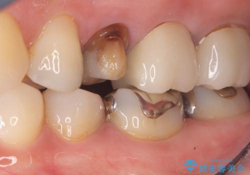 【セラミッククラウン】土台と被せものがズレている気がするの治療中