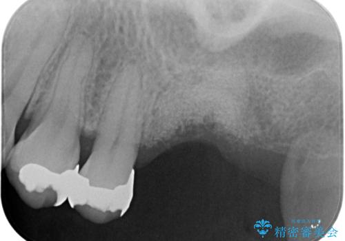 上顎奥歯のインプラント治療の治療前