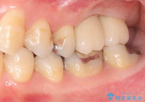 上顎奥歯のインプラント治療の治療後