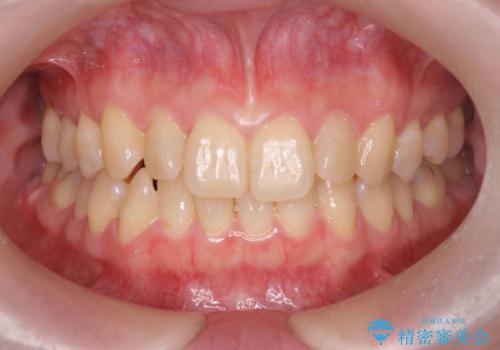 前歯のねじれを治したい リーズナブルなインビザラインモデレートプランの症例 治療前