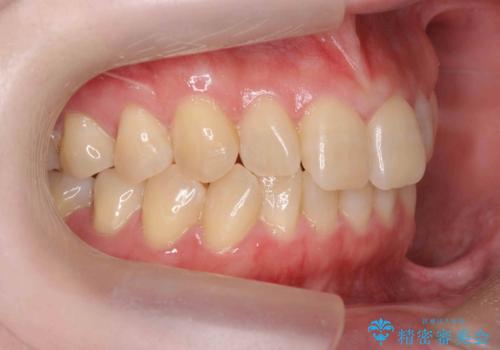 前歯のねじれを治したい リーズナブルなインビザラインモデレートプランの治療前