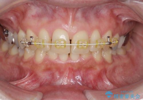 [前歯のねじれ 部分]ワイヤーとマウスピースの併用矯正治療　の治療中