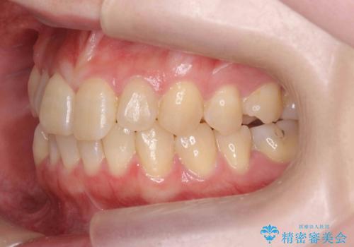 前歯のねじれを治したい リーズナブルなインビザラインモデレートプランの治療前