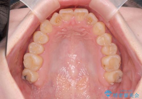 前歯のねじれを治したい リーズナブルなインビザラインモデレートプランの治療前