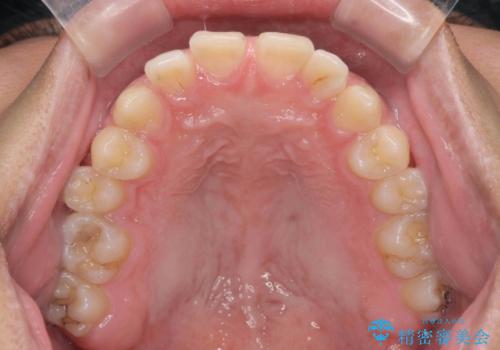[ 正中過剰埋伏歯 ]　正中離開・過蓋咬合のマウスピース矯正の治療前