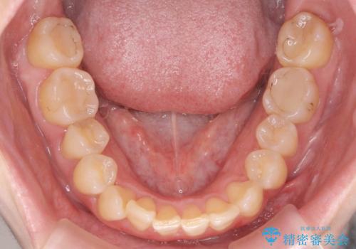 前歯のねじれを治したい リーズナブルなインビザラインモデレートプランの治療前