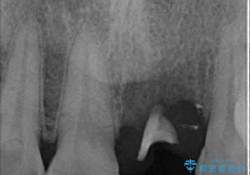 歯茎に溝が 大きく欠損した前歯のインプラント補綴治療の治療前