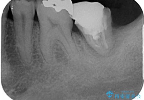 外側に飛び出している歯 部分矯正を用いた奥歯の補綴治療の治療前