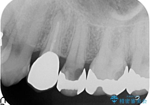 ゴールド修復後の虫歯再発 ジルコニアクラウンで精密治療の治療前