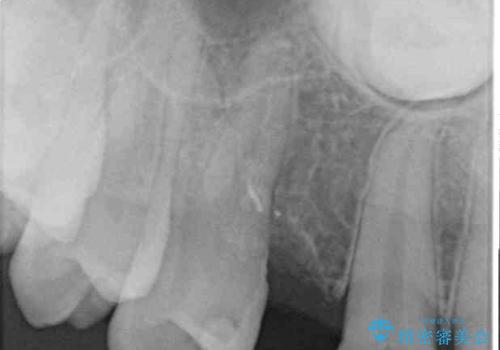 歯が生えてこない インプラントによる補綴治療の治療前