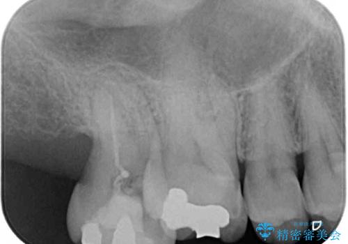 外側に飛び出している歯 部分矯正を用いた奥歯の補綴治療の治療前